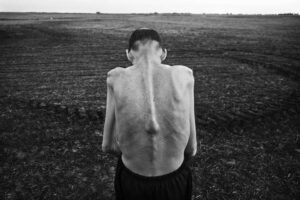 Effetti degli insetticidi sulla pelle, si vede la schiena di un uomo con la pelle rovinata